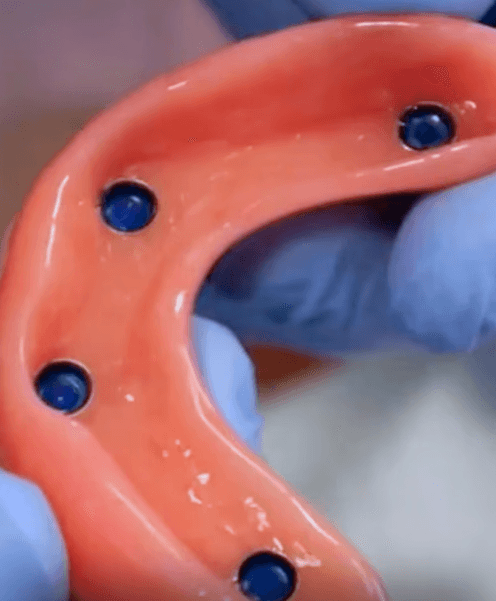 Ninja Over-Dentures – Implant Ninja official course image