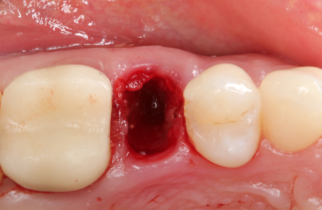 Extraction Socket Master Class – gIDE Dental Institute official course image