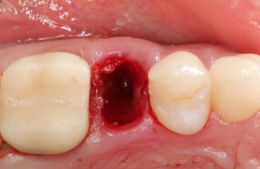 Extraction Socket Master Class – gIDE Dental Institute official course image
