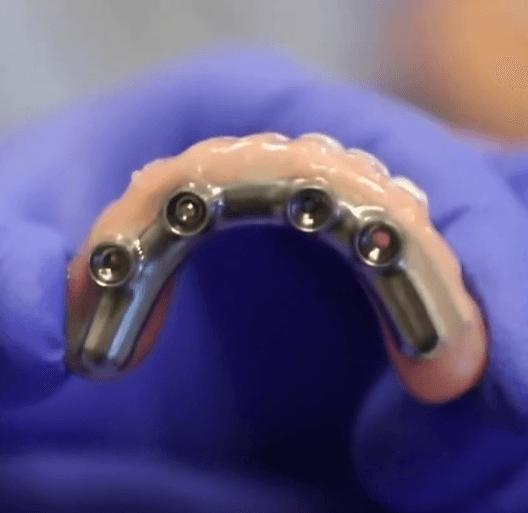 The All on X Online Course – Implant Ninja official course image