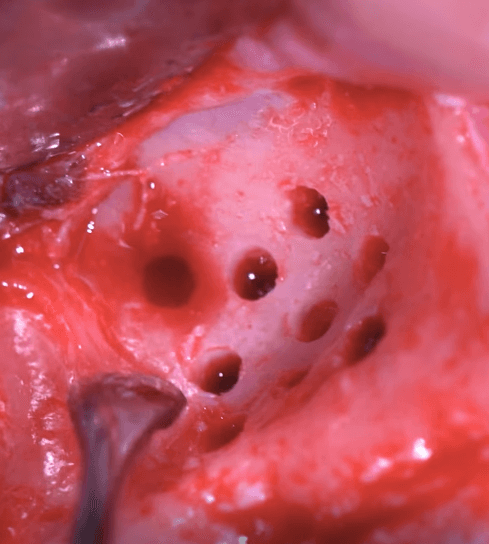Ninja GBR (Guided Bone Regeneration) – Implant Ninja official course image