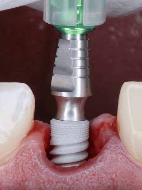Implant Surgery 101 – Implant Ninja official course image