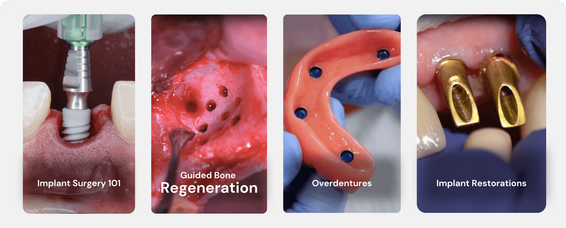 Advanced Surgical Guides AoX – Implant Ninja official brand image