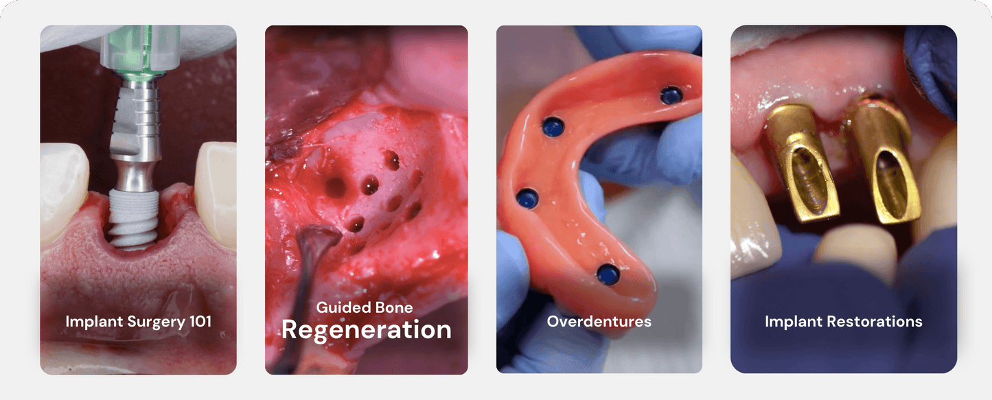 Implant Restorations (Restorative 101) – Implant Ninja official brand image