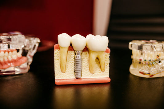 Dental implant model – stock photo (Unsplash)