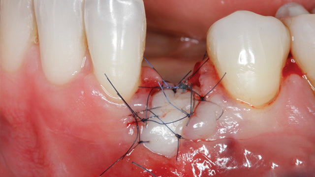Soft Tissue Management around Natural Teeth and Dental Implants – gIDE Dental Institute master class